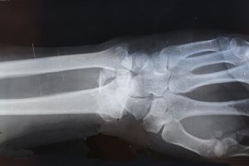 xray of lower arm and hand